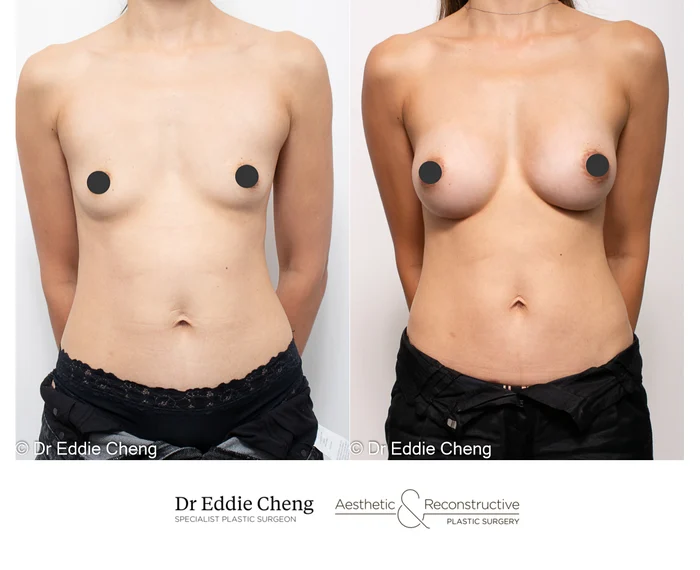 Breast Augmentation in Brisbane with Specialist Plastic Surgeon Dr Eddie Cheng - 7