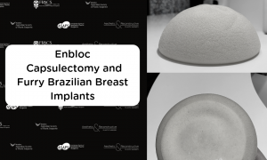 Enbloc Capsulectomy and Furry Brazilians or Polyurethane Breast Implants - 4