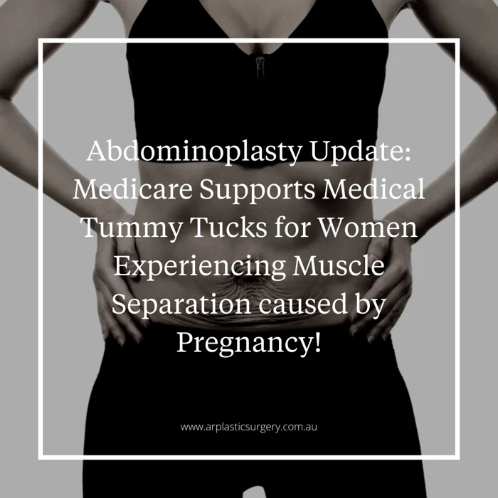 Abdominoplasty Update: Medicare Supports Medical Tummy Tucks for Women Experiencing Muscle Separation Caused by Pregnancy! - 8