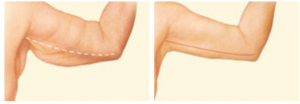 Arm Lift 2 Arm Lift - 2