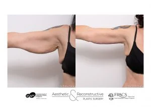 Arm Lift 4 Arm Lift - 4