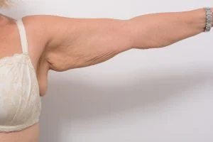 Arm Lift 6 Arm Lift - 6