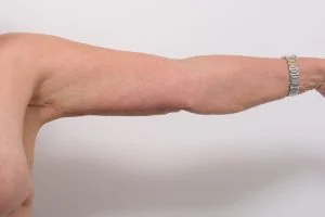 Arm Lift 7 Arm Lift - 7