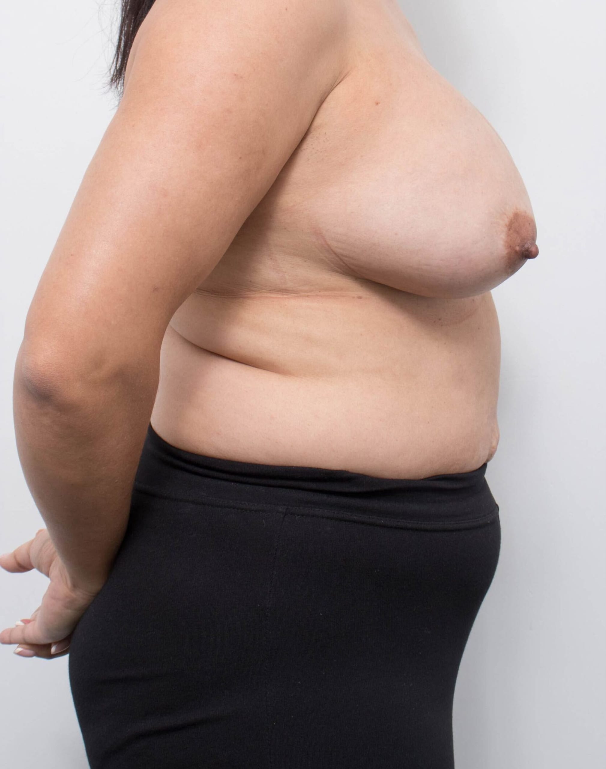 Before and after breast reduction surgery by Dr Eddie Cheng, Brisbane