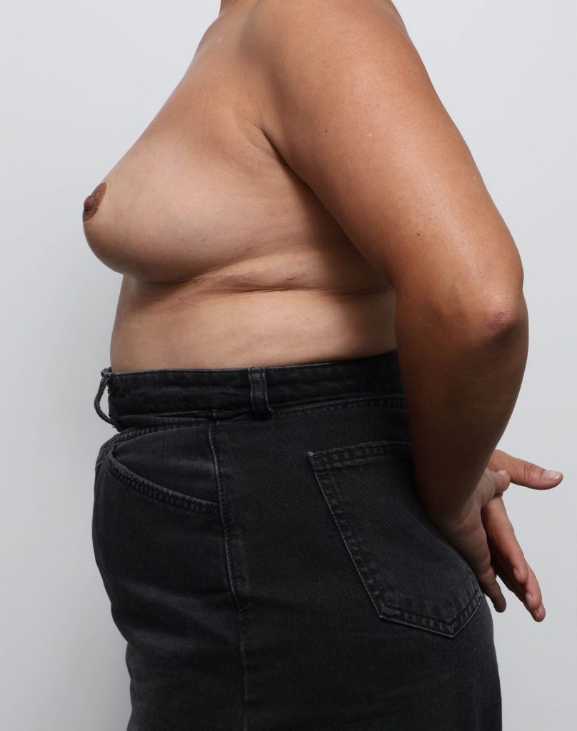 Before and after breast reduction surgery by Dr Eddie Cheng, Brisbane