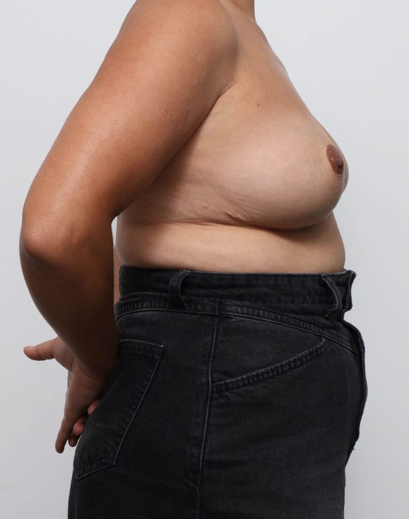 Before and after breast reduction surgery by Dr Eddie Cheng, Brisbane