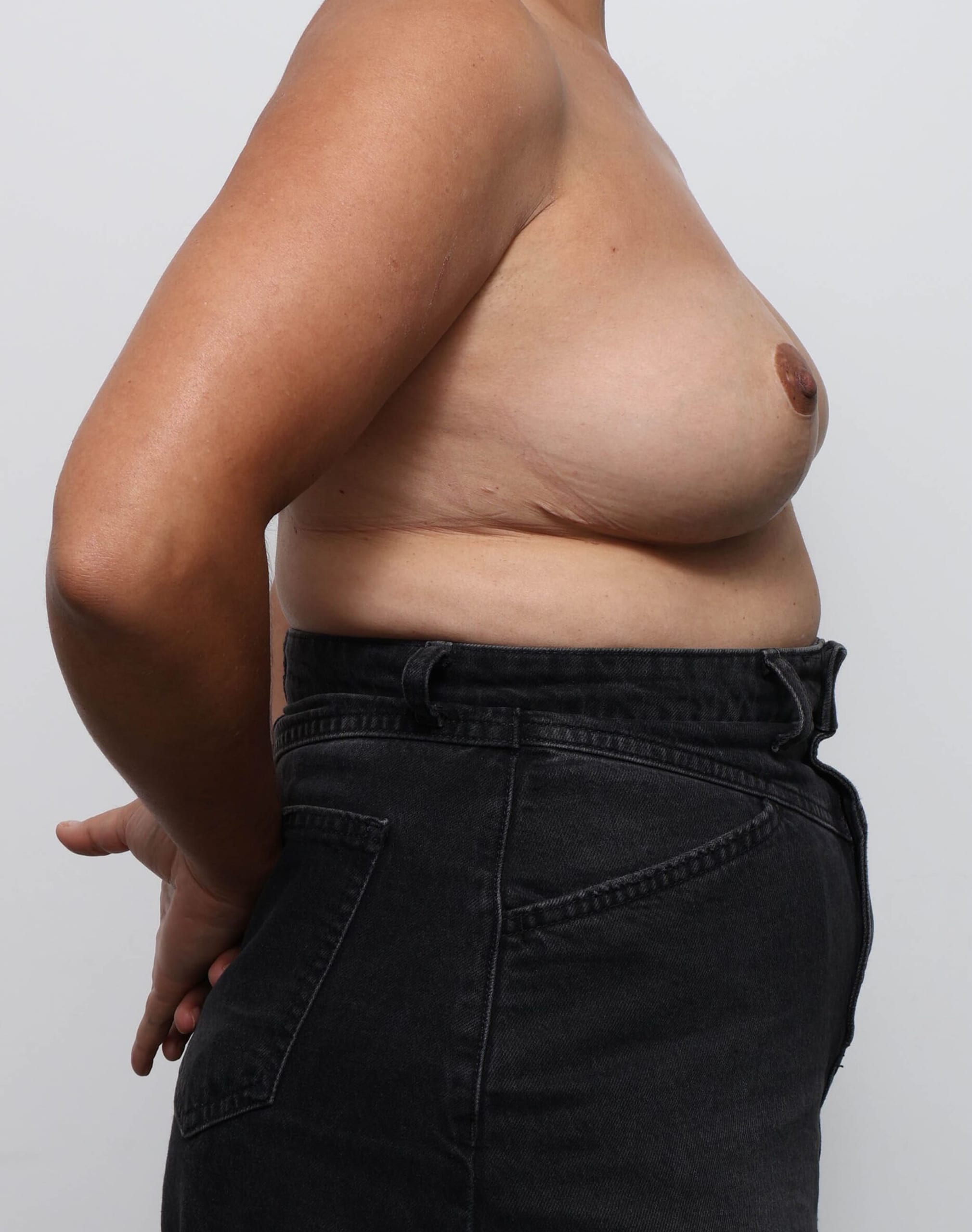 Before and after breast reduction surgery by Dr Eddie Cheng, Brisbane