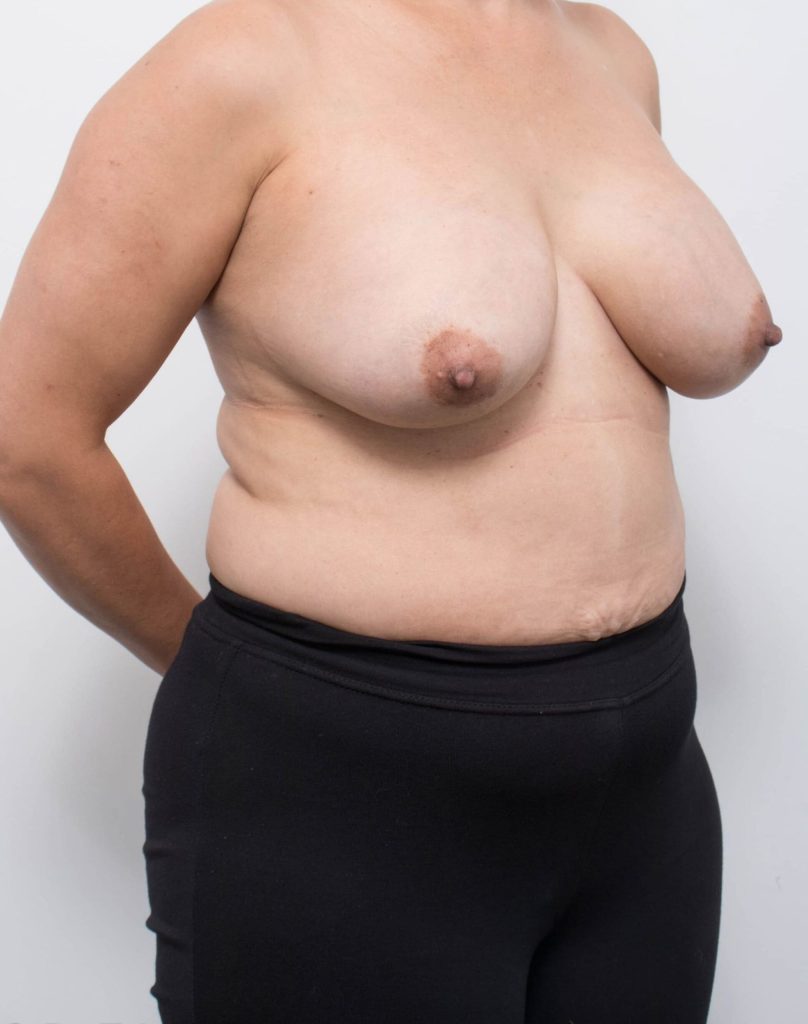 Before and after breast reduction surgery by Dr Eddie Cheng, Brisbane
