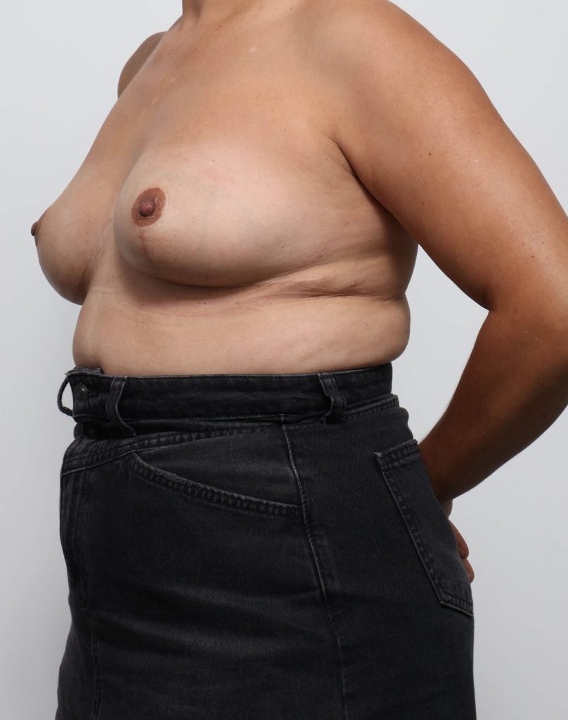 Before and after breast reduction surgery by Dr Eddie Cheng, Brisbane