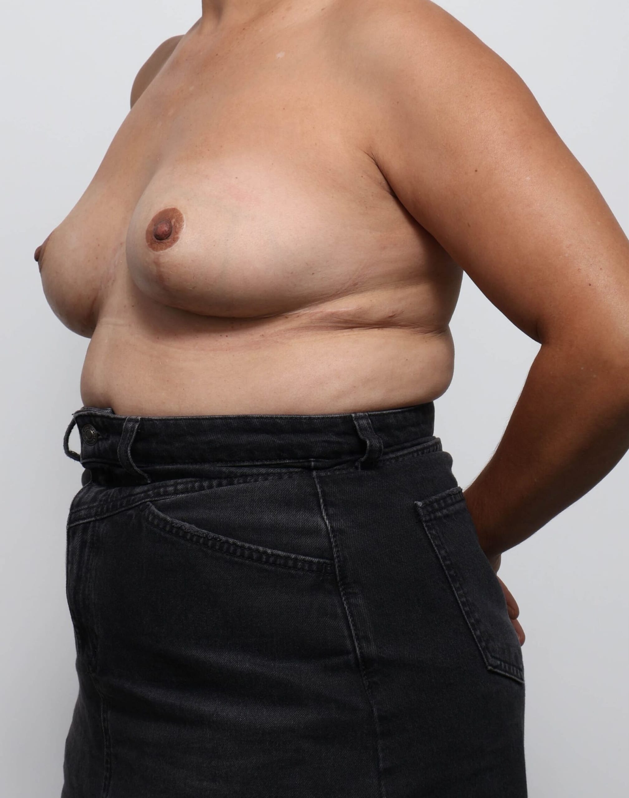 Before and after breast reduction surgery by Dr Eddie Cheng, Brisbane