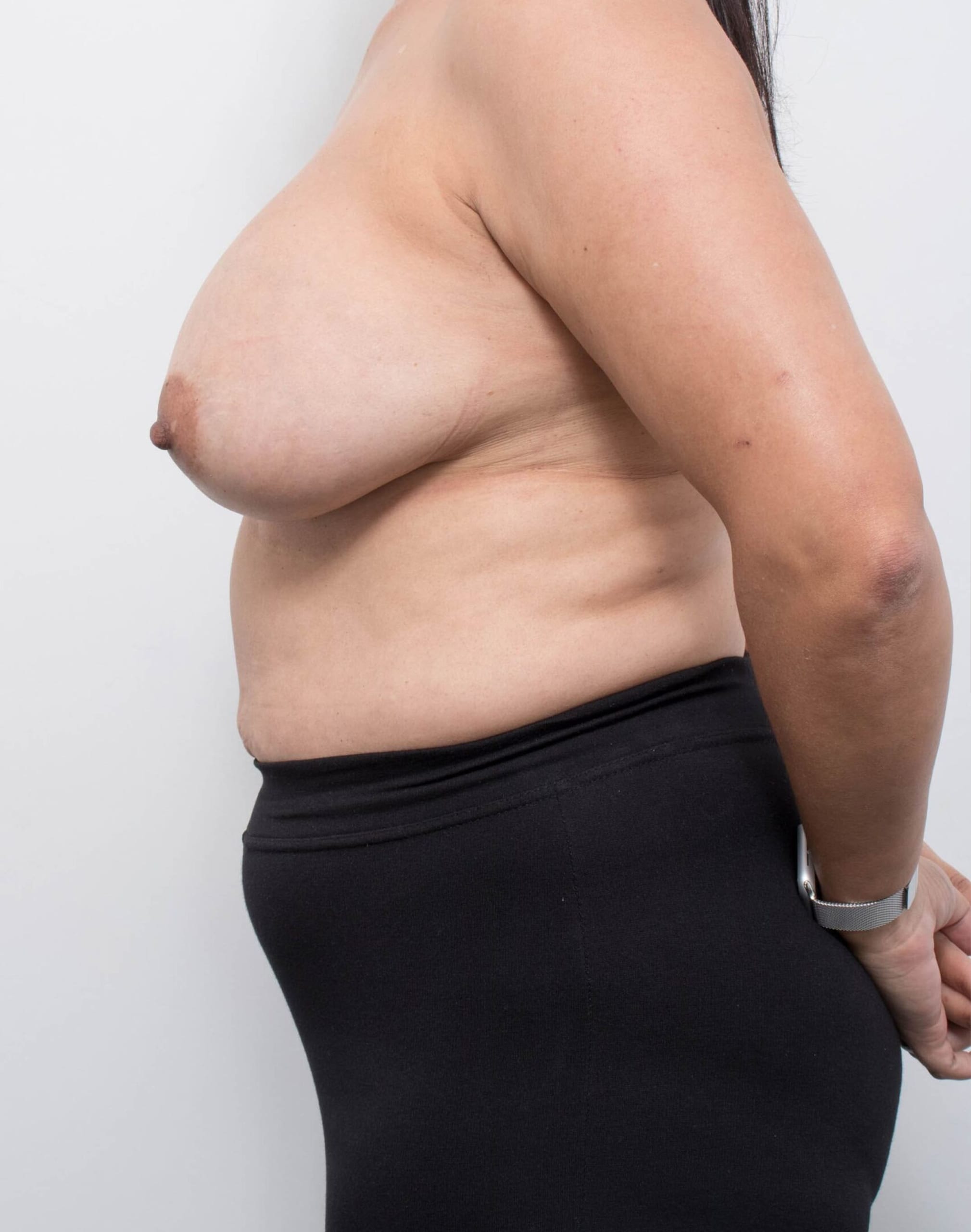 Before and after breast reduction surgery by Dr Eddie Cheng, Brisbane