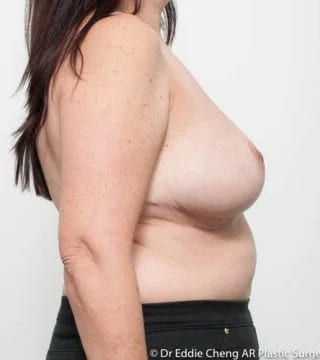 Before and after breast reduction by Dr Eddie Cheng, Brisbane