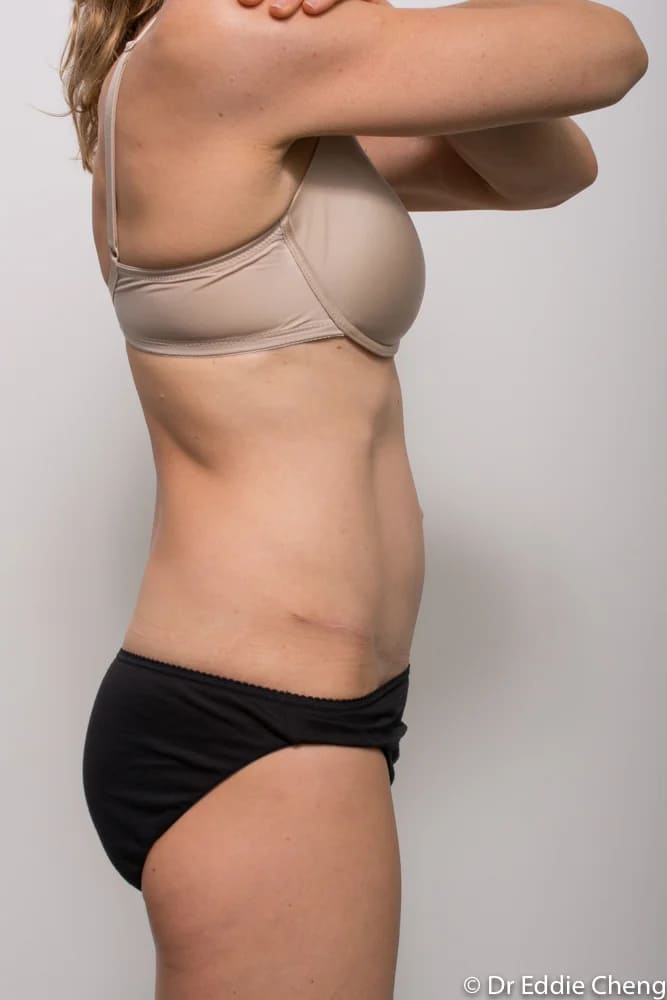 Before and after tummy tuck by Dr Eddie Cheng, Brisbane