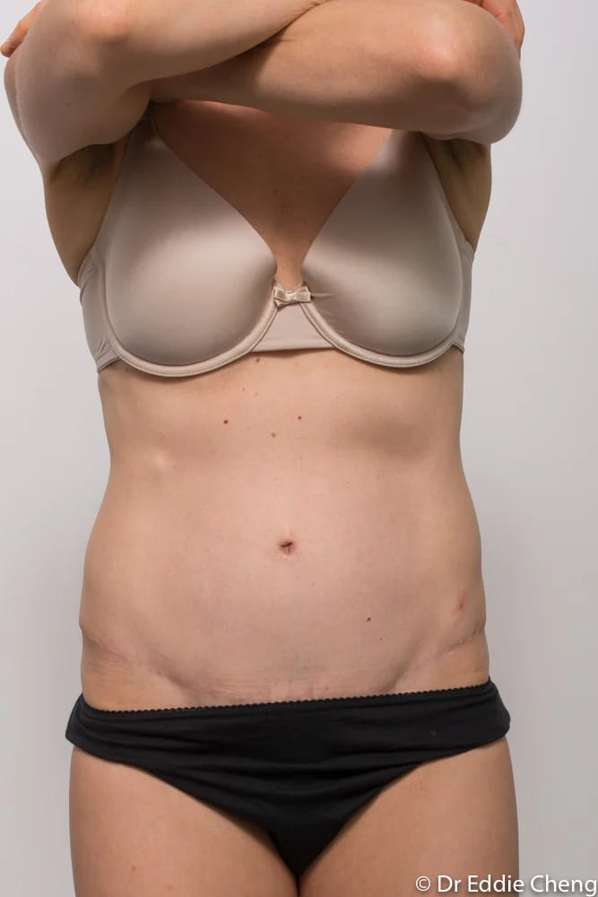 Before and after tummy tuck by Dr Eddie Cheng, Brisbane
