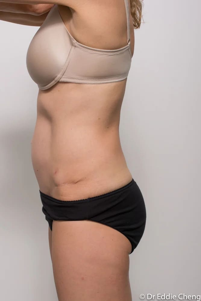 Before and after tummy tuck by Dr Eddie Cheng, Brisbane