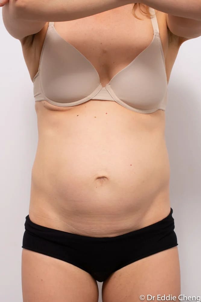 Before and after tummy tuck by Dr Eddie Cheng, Brisbane