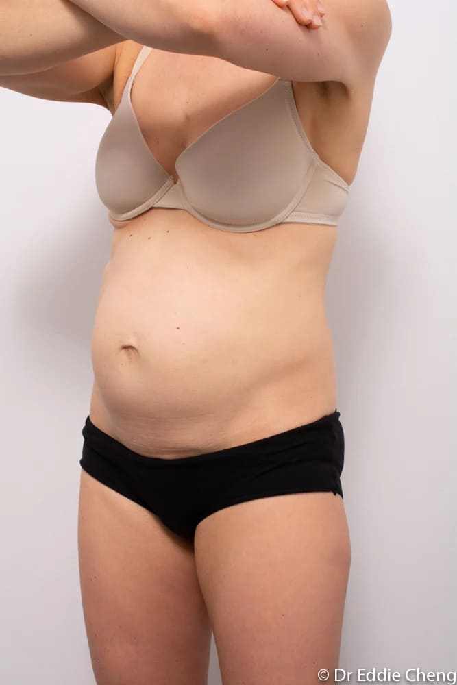 Before and after tummy tuck by Dr Eddie Cheng, Brisbane