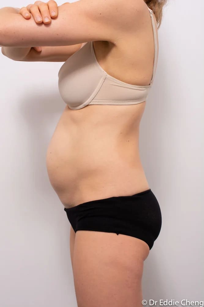 Before and after tummy tuck by Dr Eddie Cheng, Brisbane