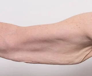 Before and after arm lift surgery by Dr Eddie Cheng, AR Plastic Surgery Brisbane