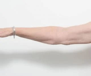 Before and after arm lift surgery by Dr Eddie Cheng, AR Plastic Surgery Brisbane
