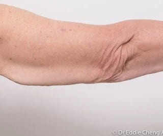 Before and after arm lift surgery by Dr Eddie Cheng, AR Plastic Surgery Brisbane
