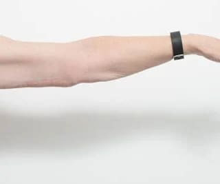 Before and after arm lift surgery by Dr Eddie Cheng, AR Plastic Surgery Brisbane