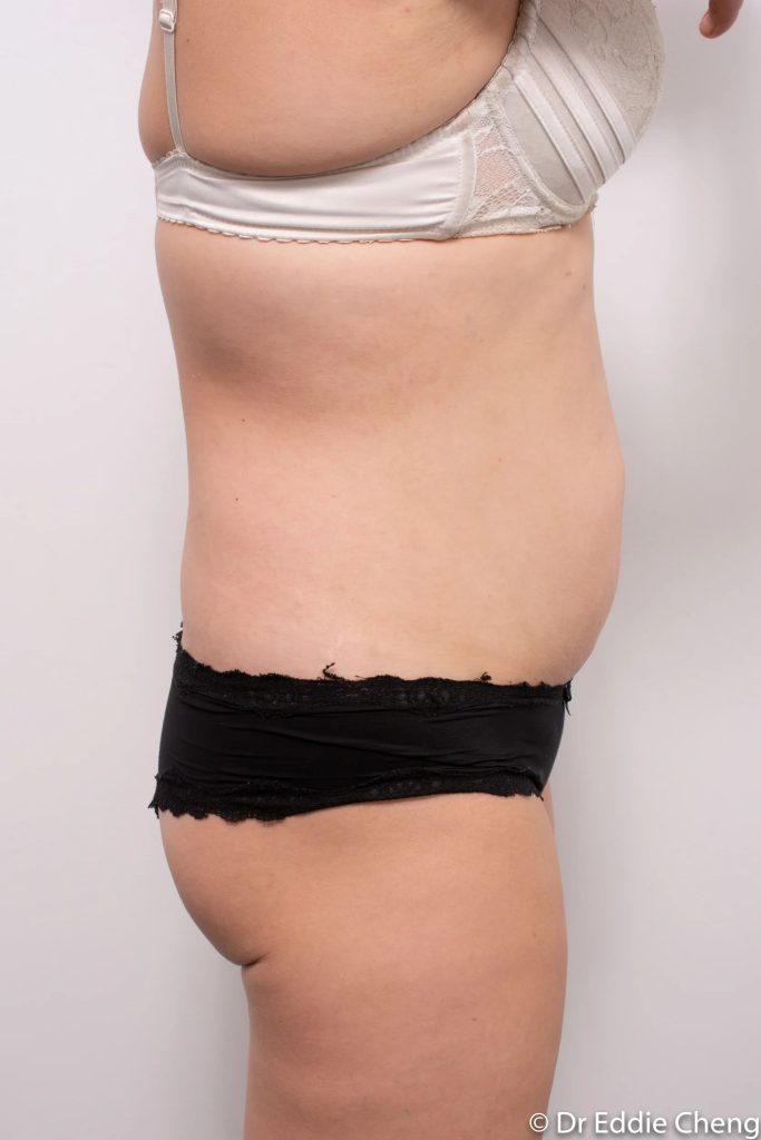 Before and after abdominoplasty by Dr Eddie Cheng, Brisbane