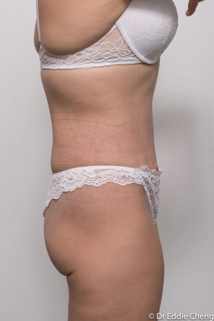 Before and after abdominoplasty by Dr Eddie Cheng, Brisbane