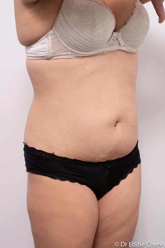 Before and after abdominoplasty by Dr Eddie Cheng, Brisbane