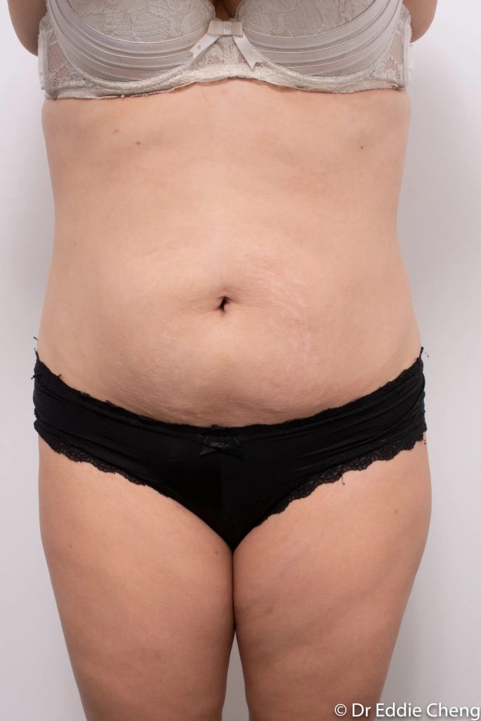 Before and after abdominoplasty by Dr Eddie Cheng, Brisbane