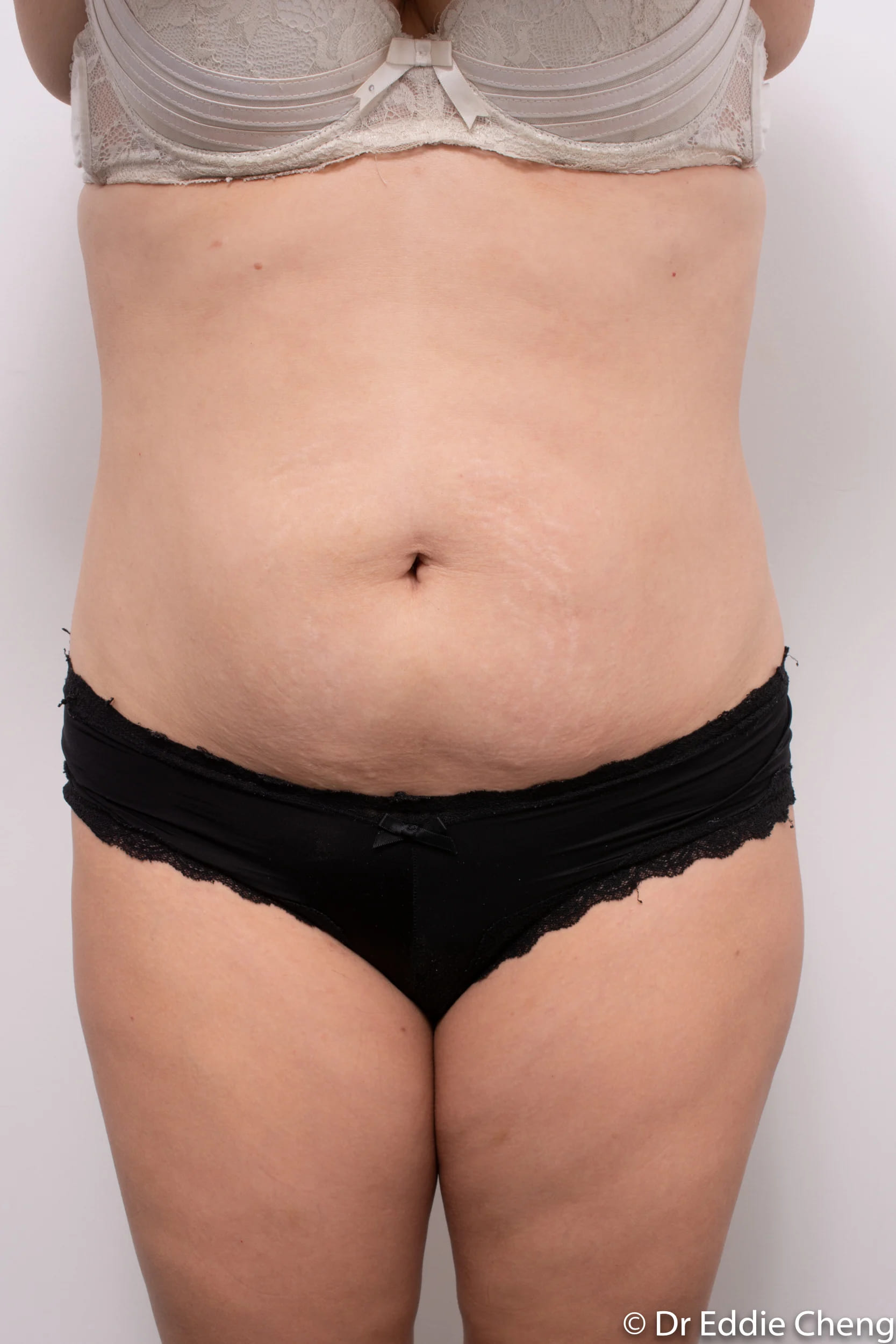 Before and after abdominoplasty by Dr Eddie Cheng, Brisbane