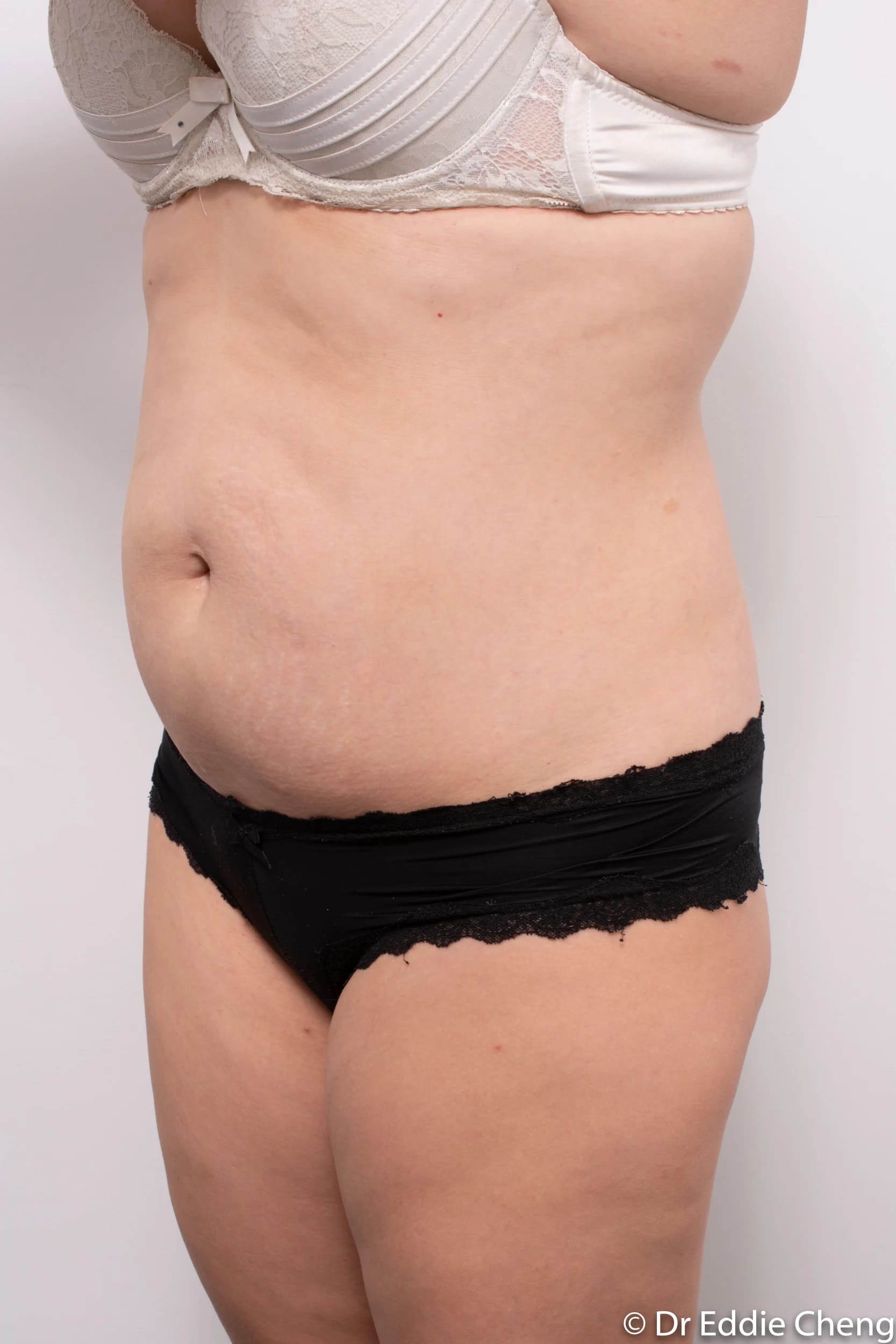 Before and after abdominoplasty by Dr Eddie Cheng, Brisbane