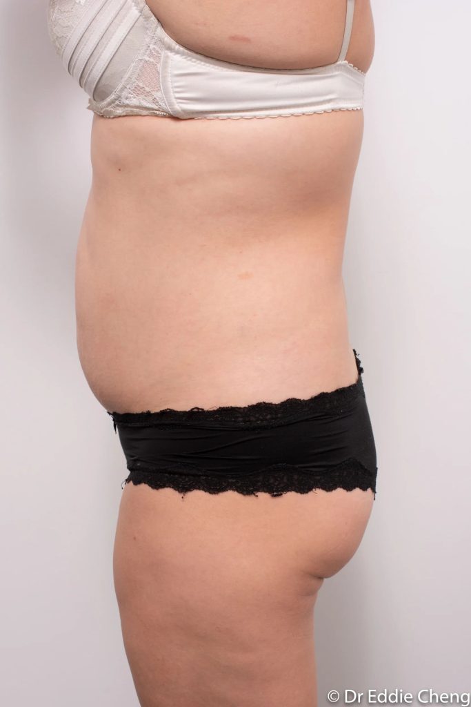 Before and after abdominoplasty by Dr Eddie Cheng, Brisbane