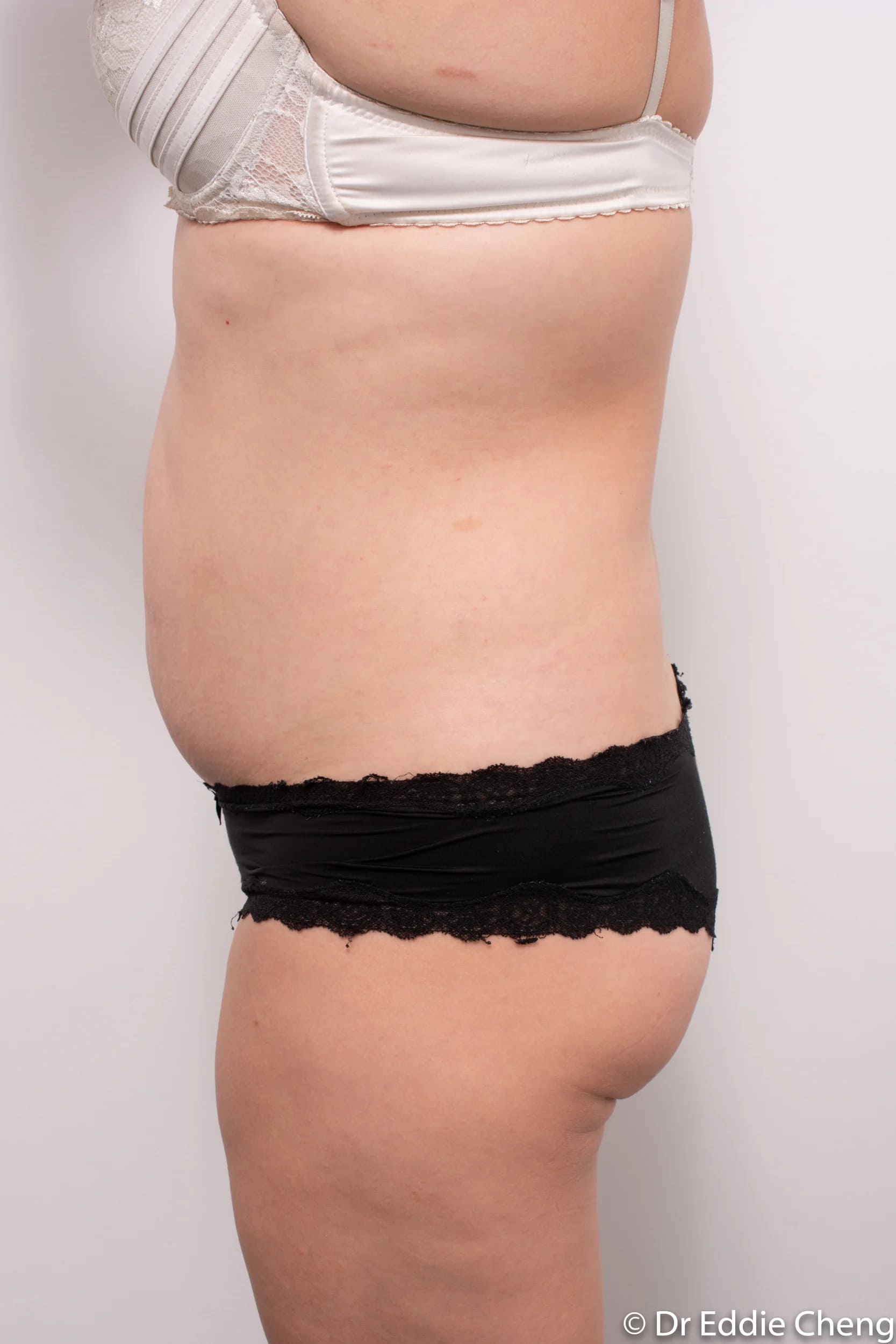 Before and after abdominoplasty by Dr Eddie Cheng, Brisbane
