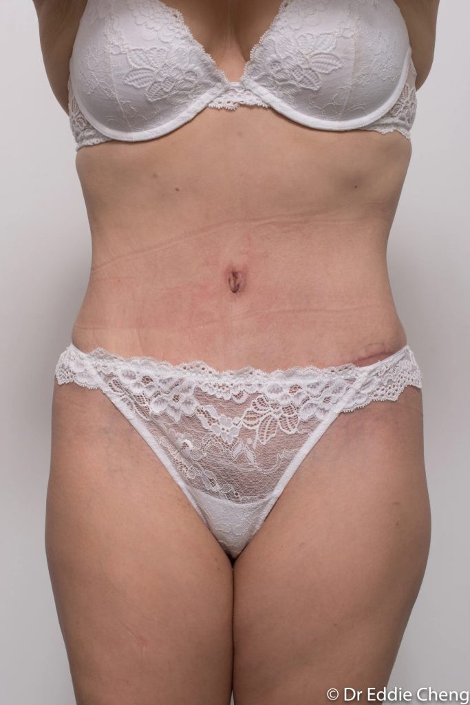 Before and after abdominoplasty by Dr Eddie Cheng, Brisbane