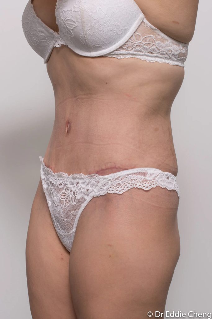 Before and after abdominoplasty by Dr Eddie Cheng, Brisbane