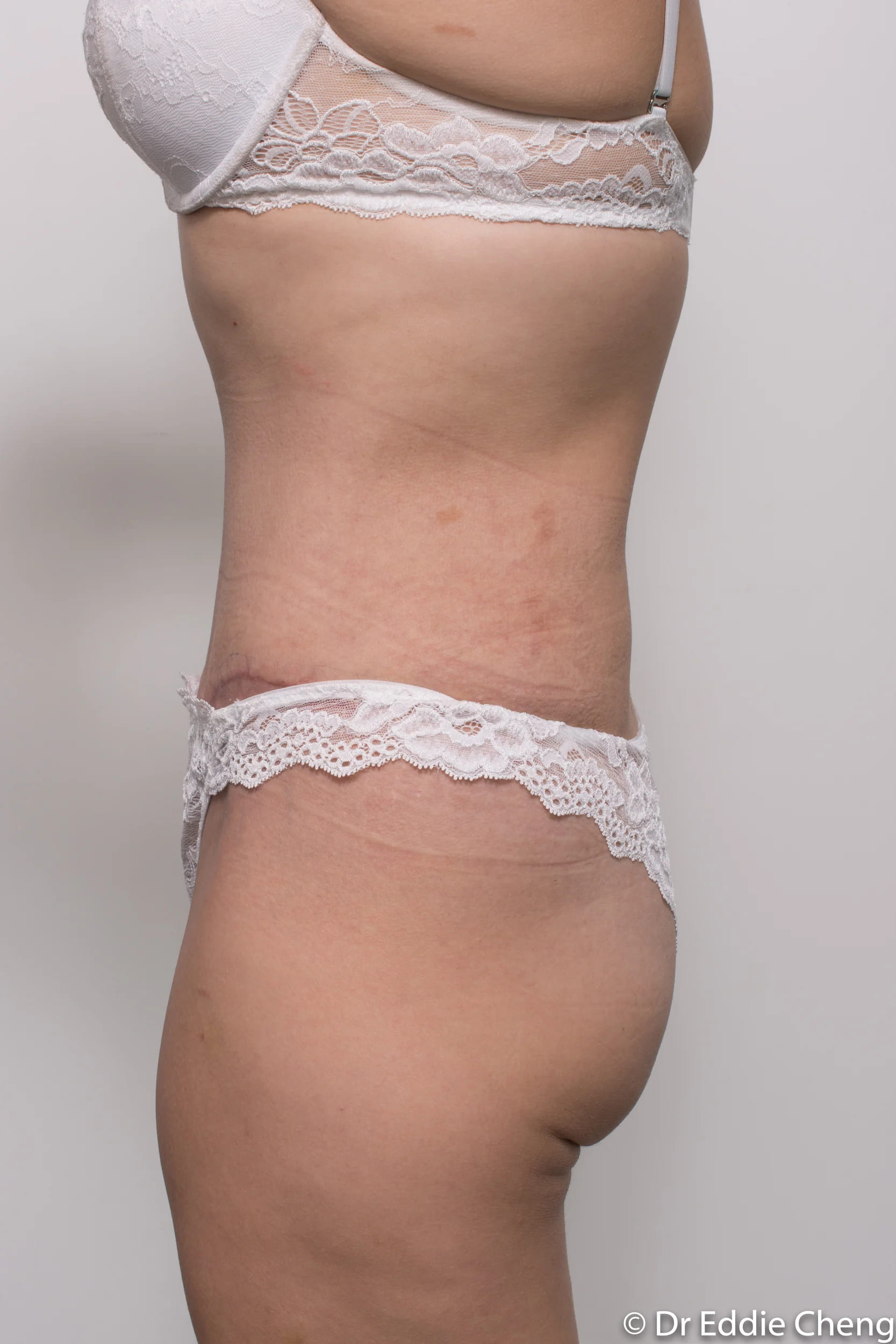 Before and after abdominoplasty by Dr Eddie Cheng, Brisbane