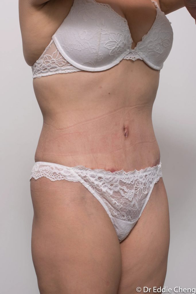Before and after abdominoplasty by Dr Eddie Cheng, Brisbane
