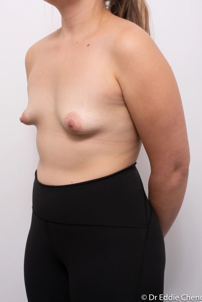 Before and after breast augmentation by Dr Eddie Cheng, Brisbane