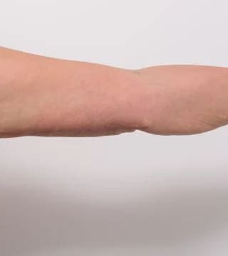 Before and after breast augmentation by Dr Eddie Cheng, Brisbane