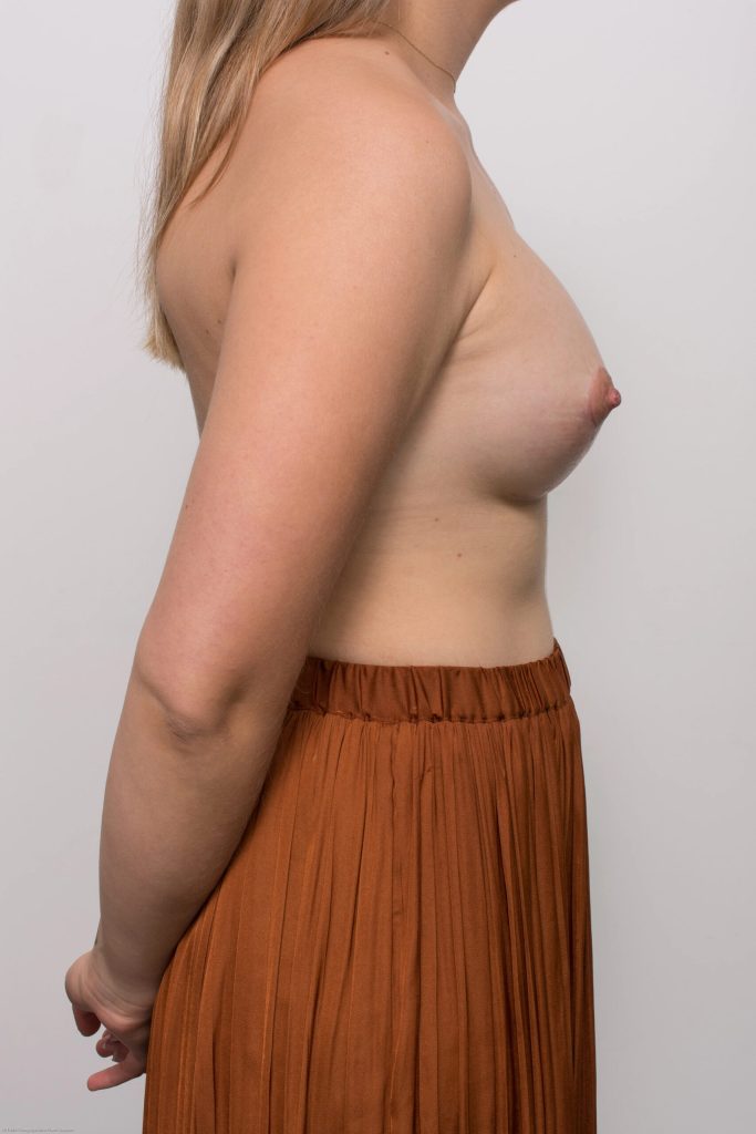 Before and after breast augmentation by Dr Eddie Cheng, Brisbane