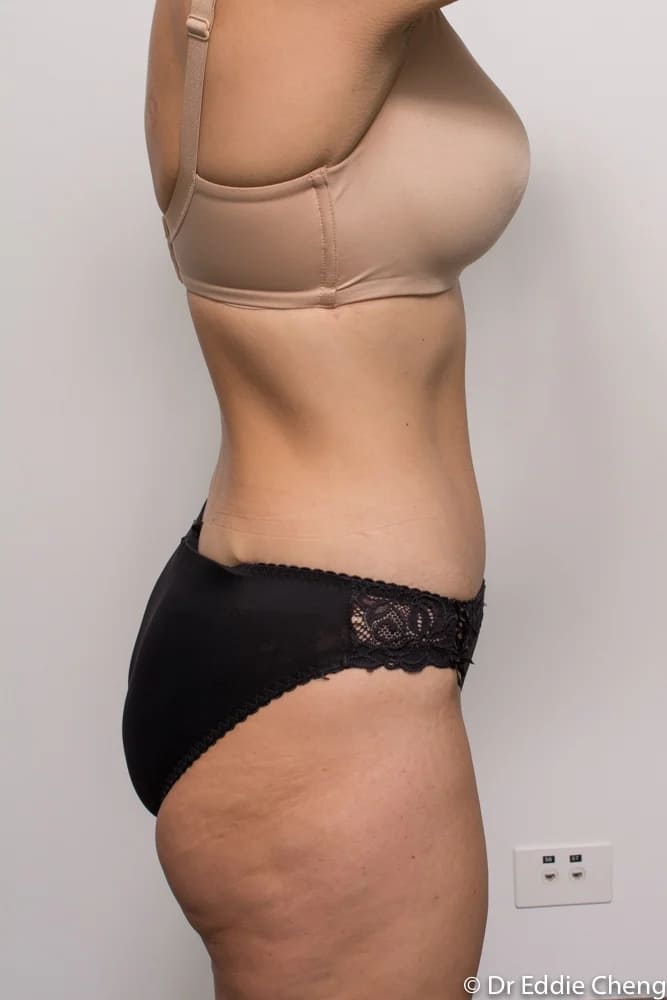 Before and after tummy tuck by Dr Eddie Cheng, Brisbane