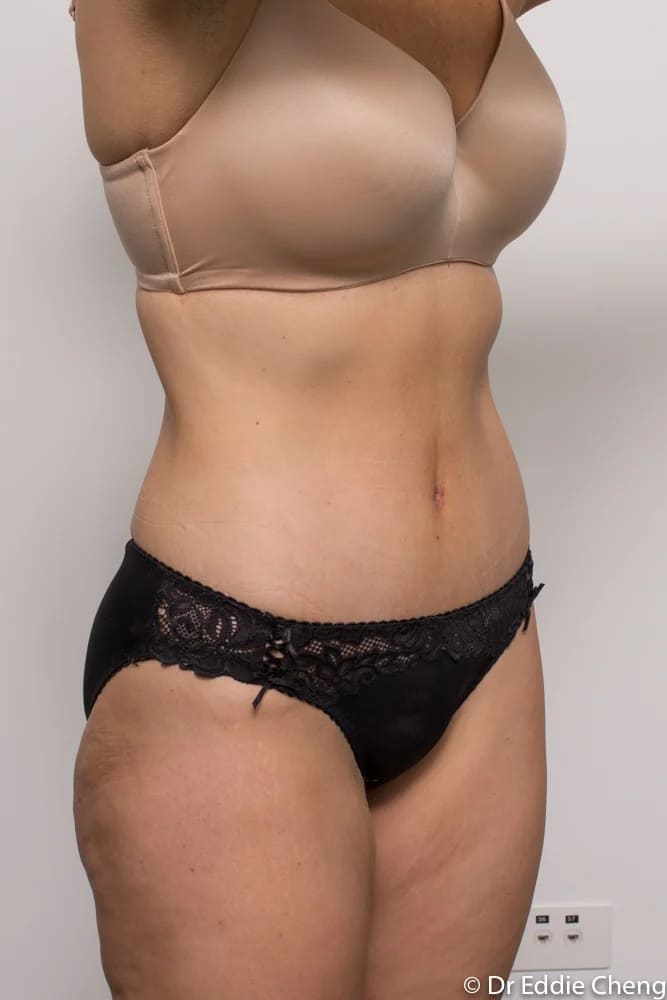 Before and after tummy tuck by Dr Eddie Cheng, Brisbane