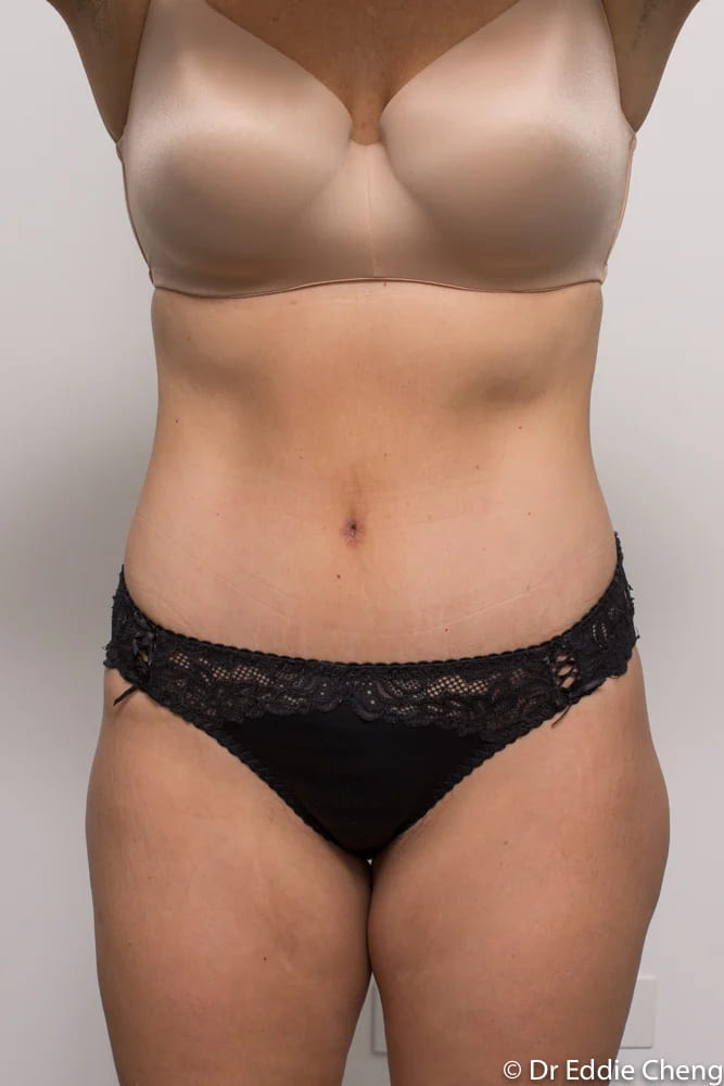 Before and after tummy tuck by Dr Eddie Cheng, Brisbane