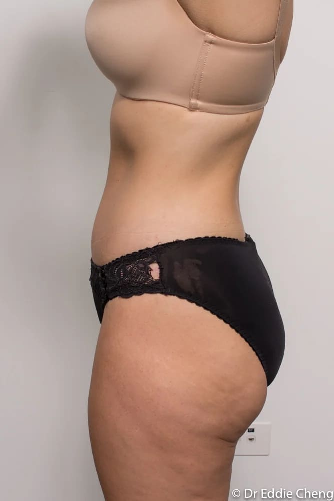 Before and after tummy tuck by Dr Eddie Cheng, Brisbane
