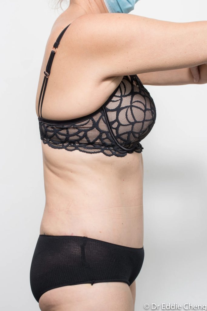 Before and after tummy tuck by Dr Eddie Cheng, Brisbane