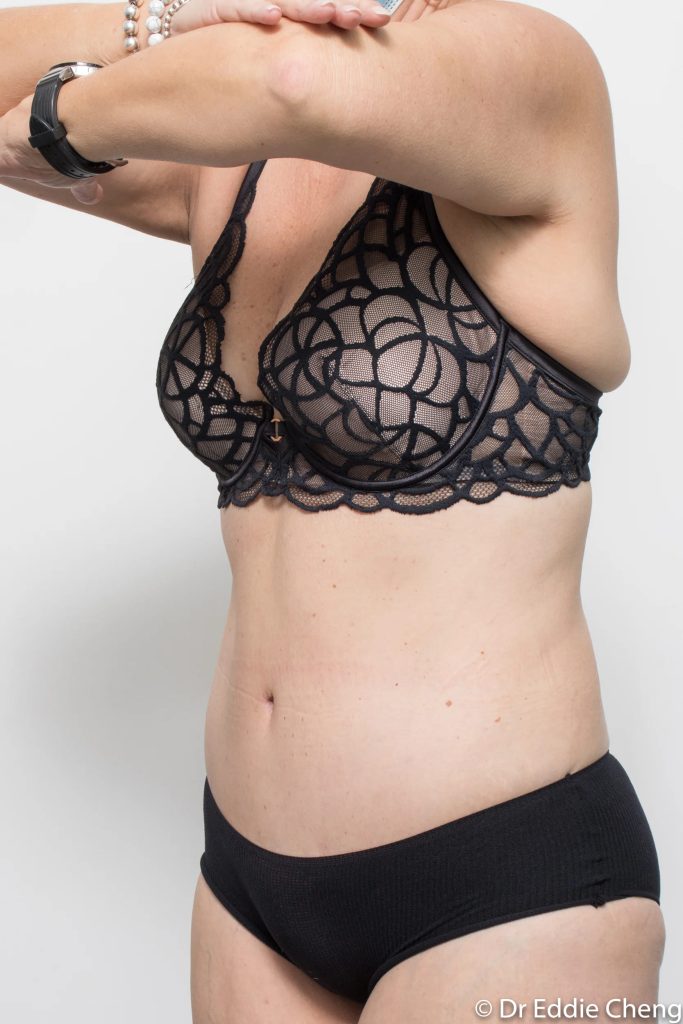 Before and after tummy tuck by Dr Eddie Cheng, Brisbane