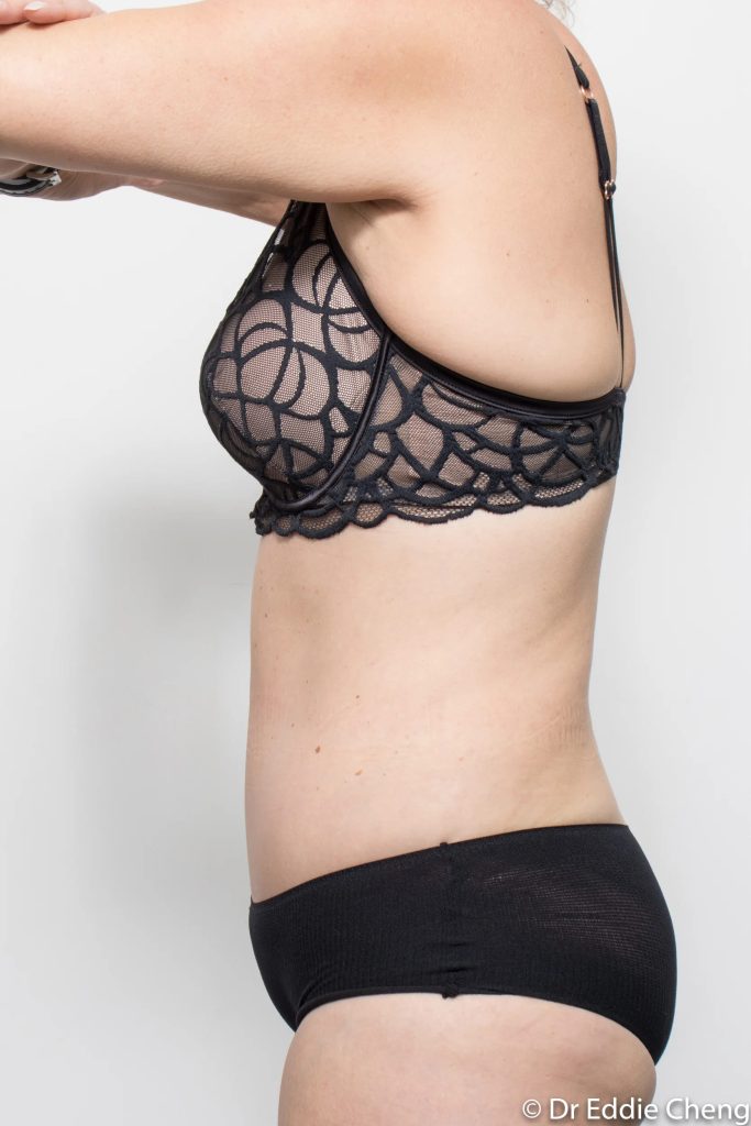 Before and after tummy tuck by Dr Eddie Cheng, Brisbane