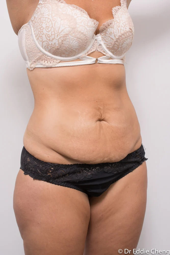 Before and after tummy tuck by Dr Eddie Cheng, Brisbane