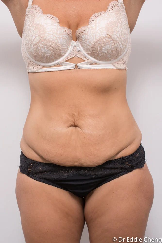 Before and after tummy tuck by Dr Eddie Cheng, Brisbane